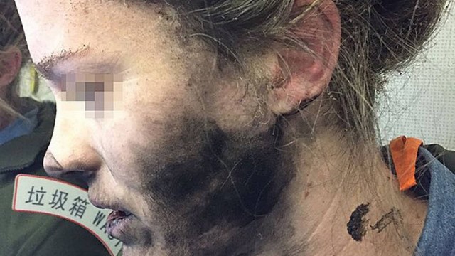 O rosto da mulher foi queimado após fones de ouvido terem explodido Foto: Australian Transport Safety Bureau - AAP