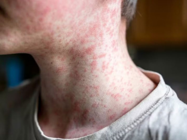 Américas perdem status de região livre do sarampo; doença é altamente transmissível e pode matar