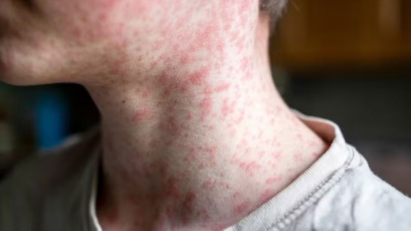 Américas perdem status de região livre do sarampo; doença é altamente transmissível e pode matar